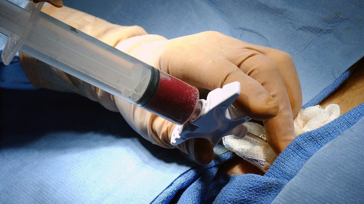 All'Annunziata è stata somministrata a paziente affetto da leucemia rara la terapia con monoclonali