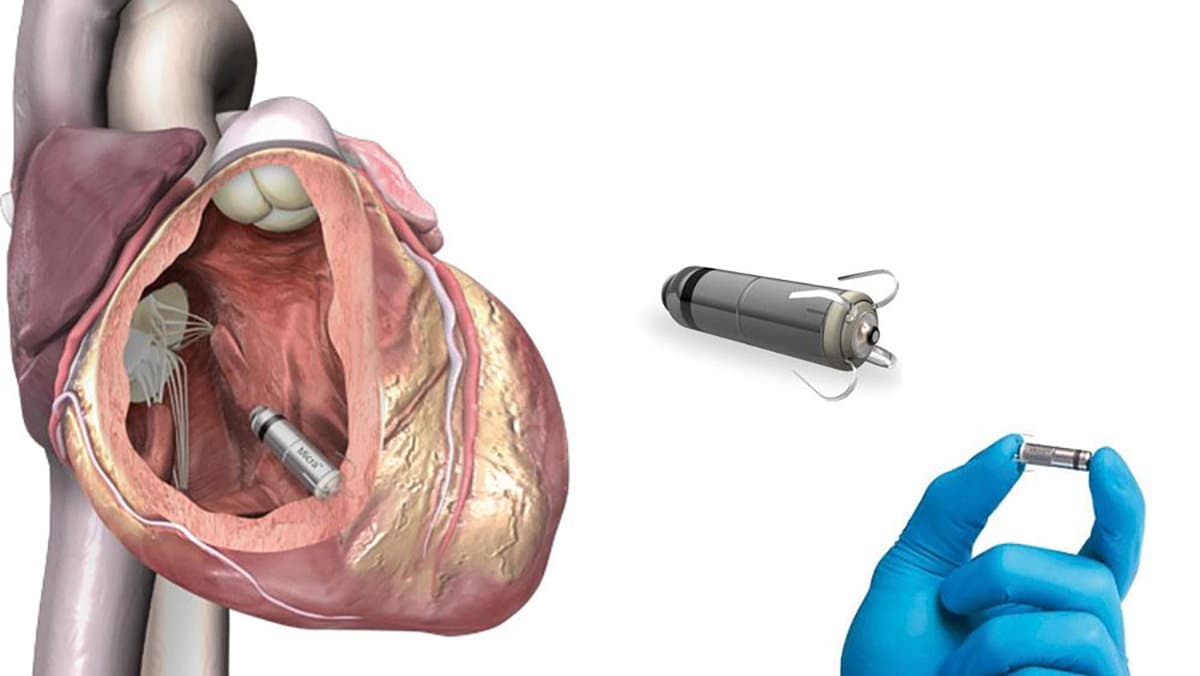 Pacemaker senza fili: non più novità sperimentale, ma procedura consolidata nella nostra Provincia